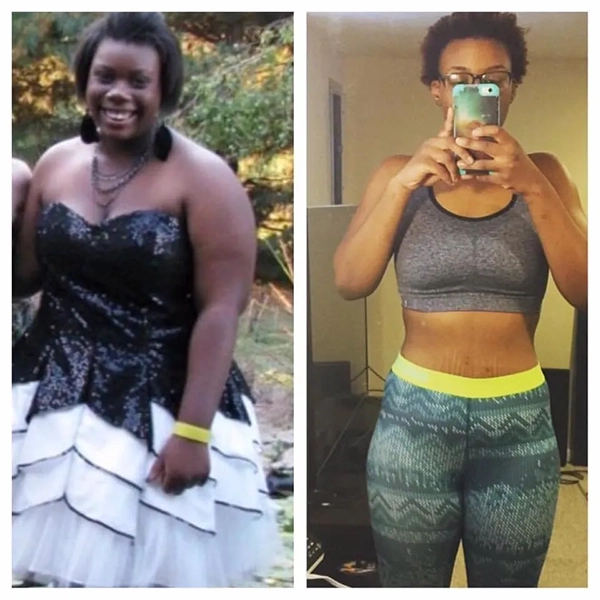 before and after photo of a young woman after successful semaglutide weight loss treatments